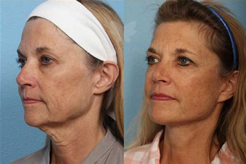 Before and After Neck Lift Surgery