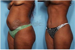 Tummy Tuck Before and After Photos 