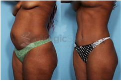 Top 3 Ways to Maintain Your Tummy Tuck Results