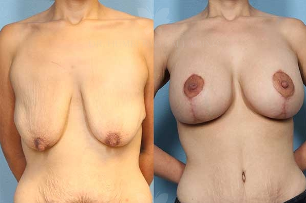 Breast Lift Before and After Photos