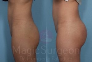 Palladino Patient Butt Implants